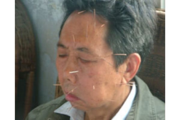 acupuntura e a paralisia facial