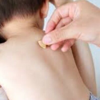 Acupuntura Japonesa na Pediatria