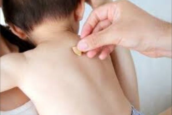 acupuntura japonesa na pediatria