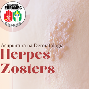acupuntura na herpes zosters