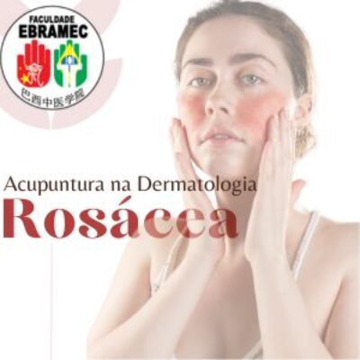 Acupuntura na Rosácea